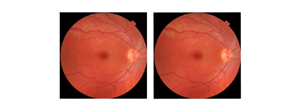 Rétinographie et Champ Visuel